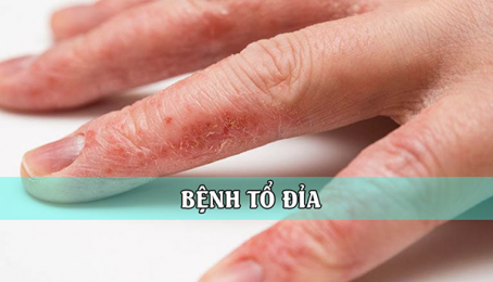 Bệnh Tổ Đỉa & Ghẻ Nước - Dấu hiệu, nguyên nhân gây bệnh và phương pháp điều trị