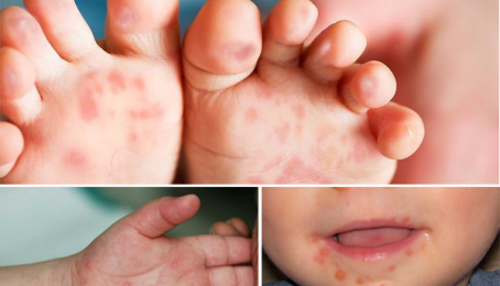 Bệnh tay chân miệng ở trẻ em, dấu hiệu nhận biết, cách phòng và điều trị