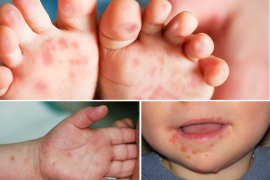 Bệnh tay chân miệng ở trẻ em, dấu hiệu nhận biết, cách phòng và điều trị