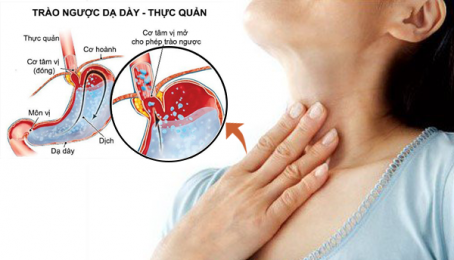 Biện pháp trị dứt điểm trào ngược dạ dày thực quản tại nhà bằng phương pháp tự nhiên