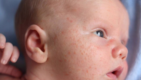 Mách mẹ 5 cách chữa chàm sữa cho trẻ sơ sinh hiệu quả, an toàn ngay tại nhà