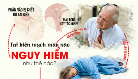 Cách phòng ngừa đột quỵ não ngay tại nhà ai cũng nên biết