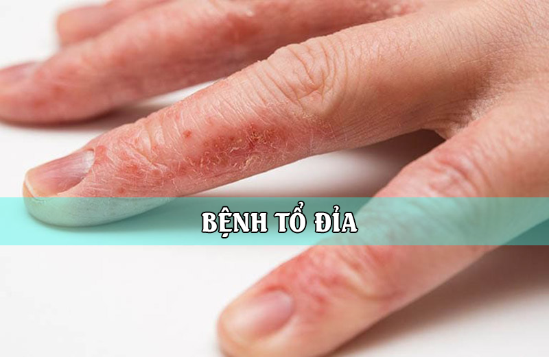 benh to dia