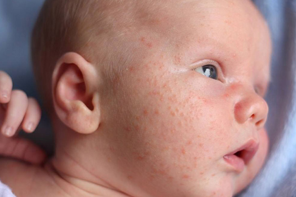 Cach chua cham sua o tre so sinh